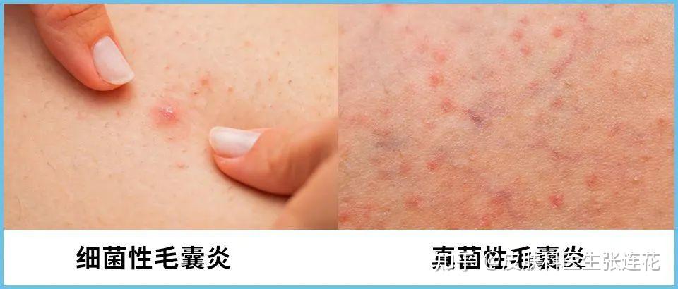 【赣州肤斗士】毛囊炎和痘痘,傻傻分不清楚?越拖越严重! - 知乎