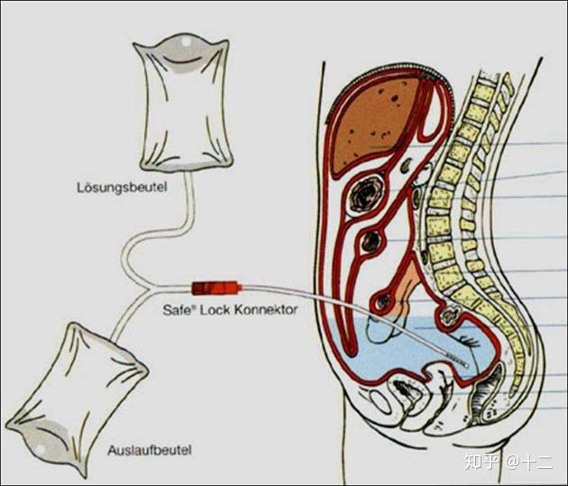 一图读懂尿毒症