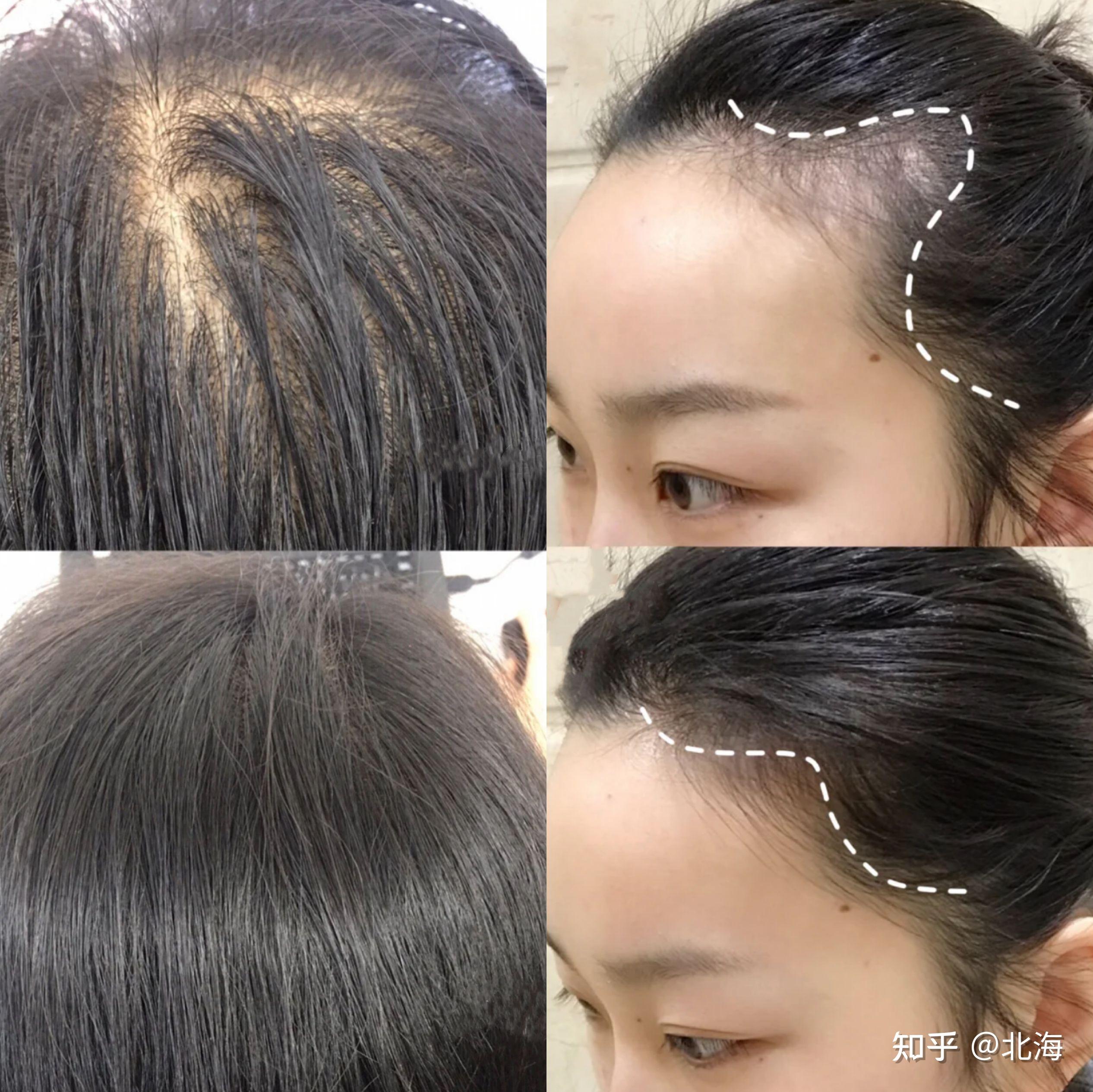 为什么医学生强烈建议你头发少到快秃的时候，一定要防脱和育发同时进行？！ - 知乎