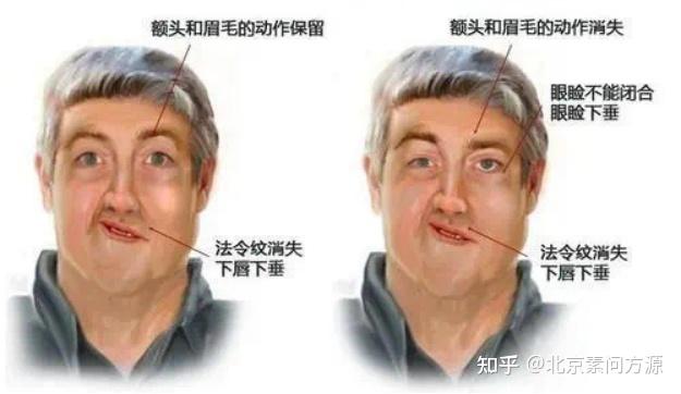 健康科普丨原来你是这样的面神经炎 - 知乎