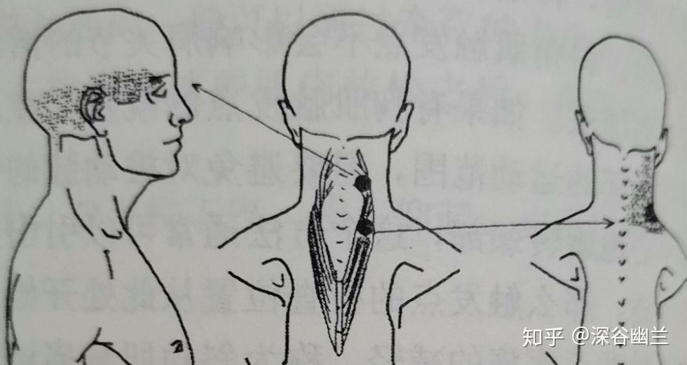 胸锁乳突肌三角定位图片