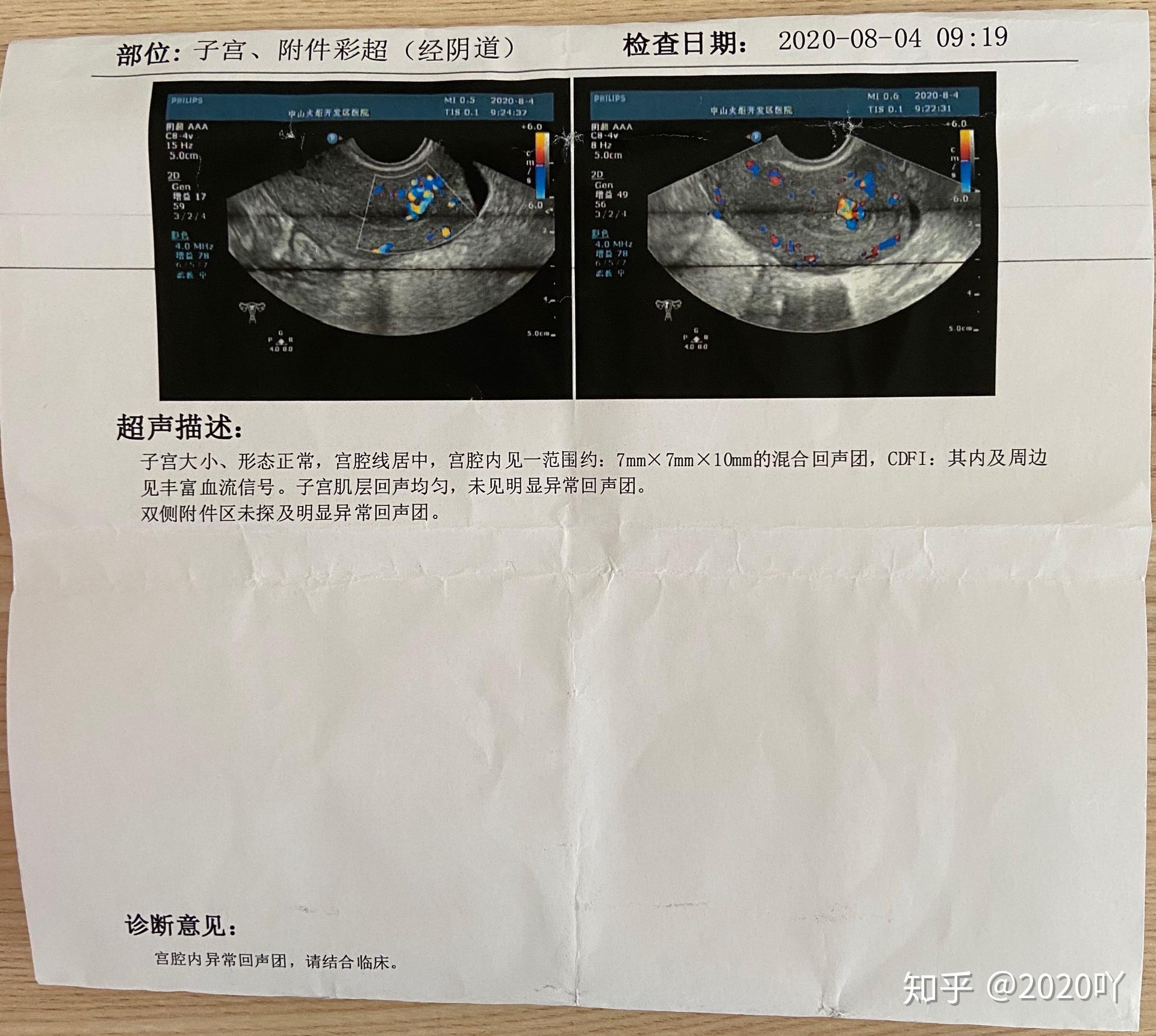 可視無痛人流殘留堅持不清宮