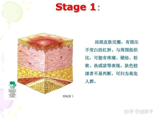 压疮（褥疮）的特点、分类及危害 - 知乎