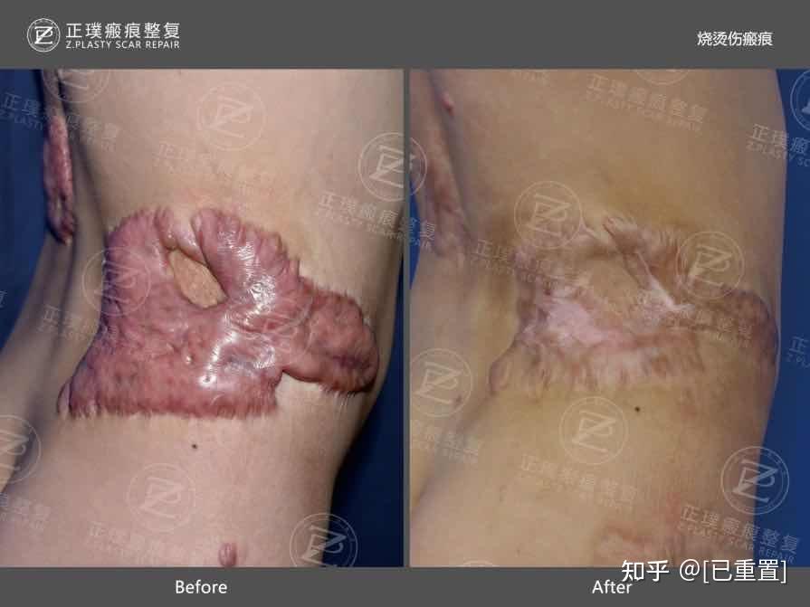 单纯切除植皮效果往往不理想,采用皮瓣转移修复效果更好;皮肤软组织