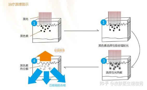 激光洗皮秒的作用原理
