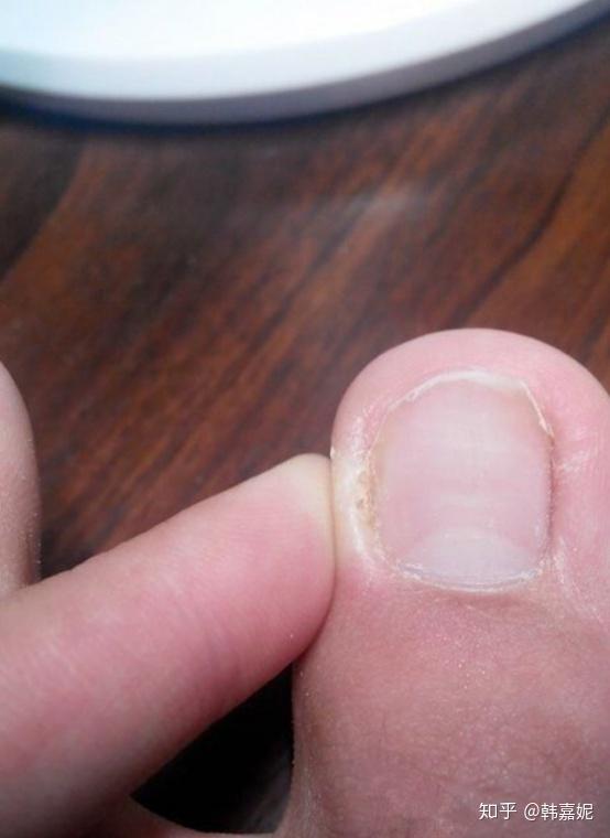 指甲变厚变空的原因是什么是灰指甲吗