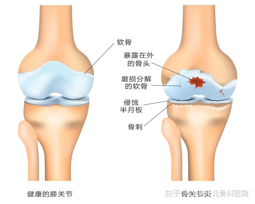 膝盖得了骨关节炎该怎么办!