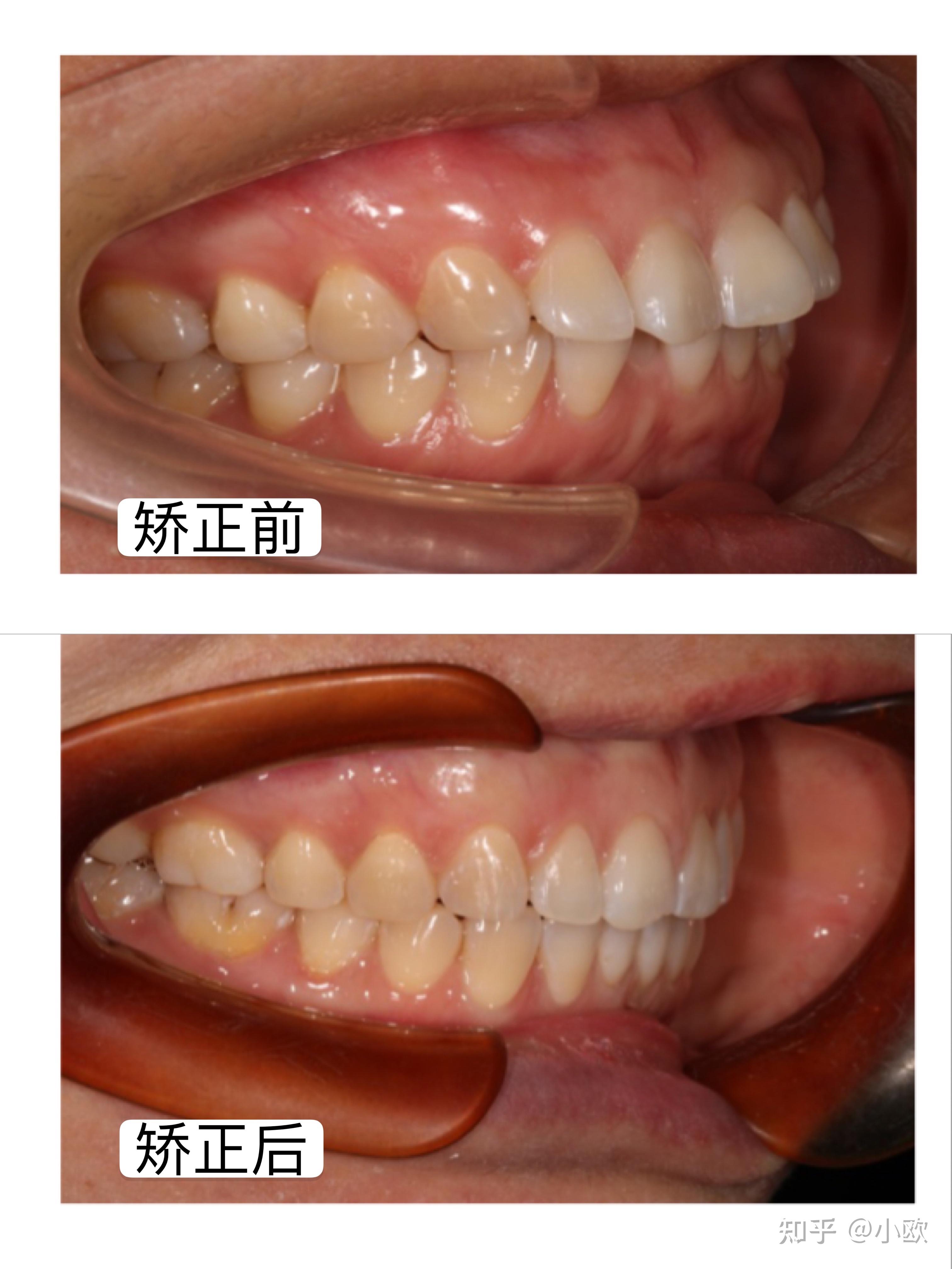 凸嘴牙齿矫正效果图图片