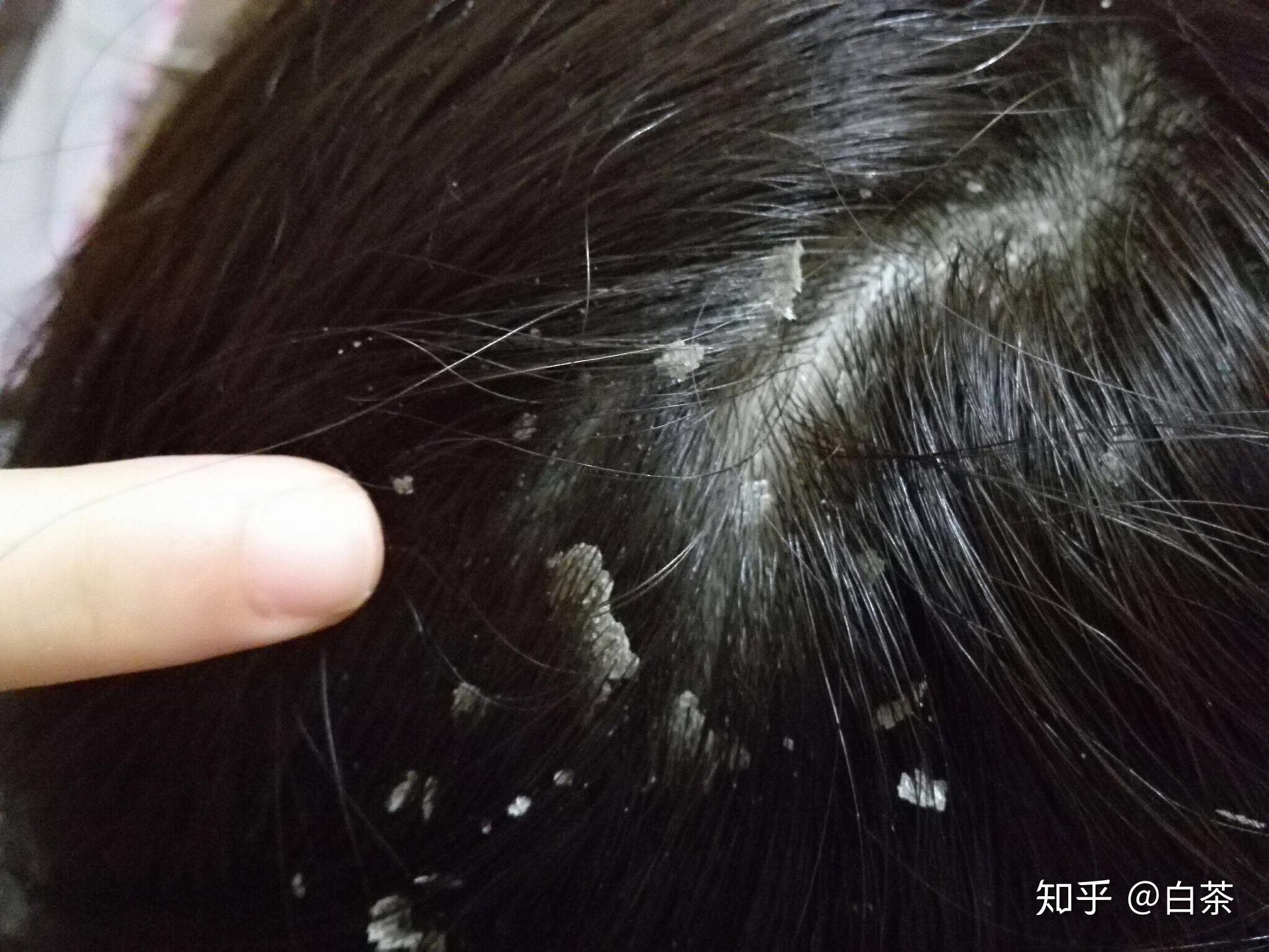 头屑很多怎么办