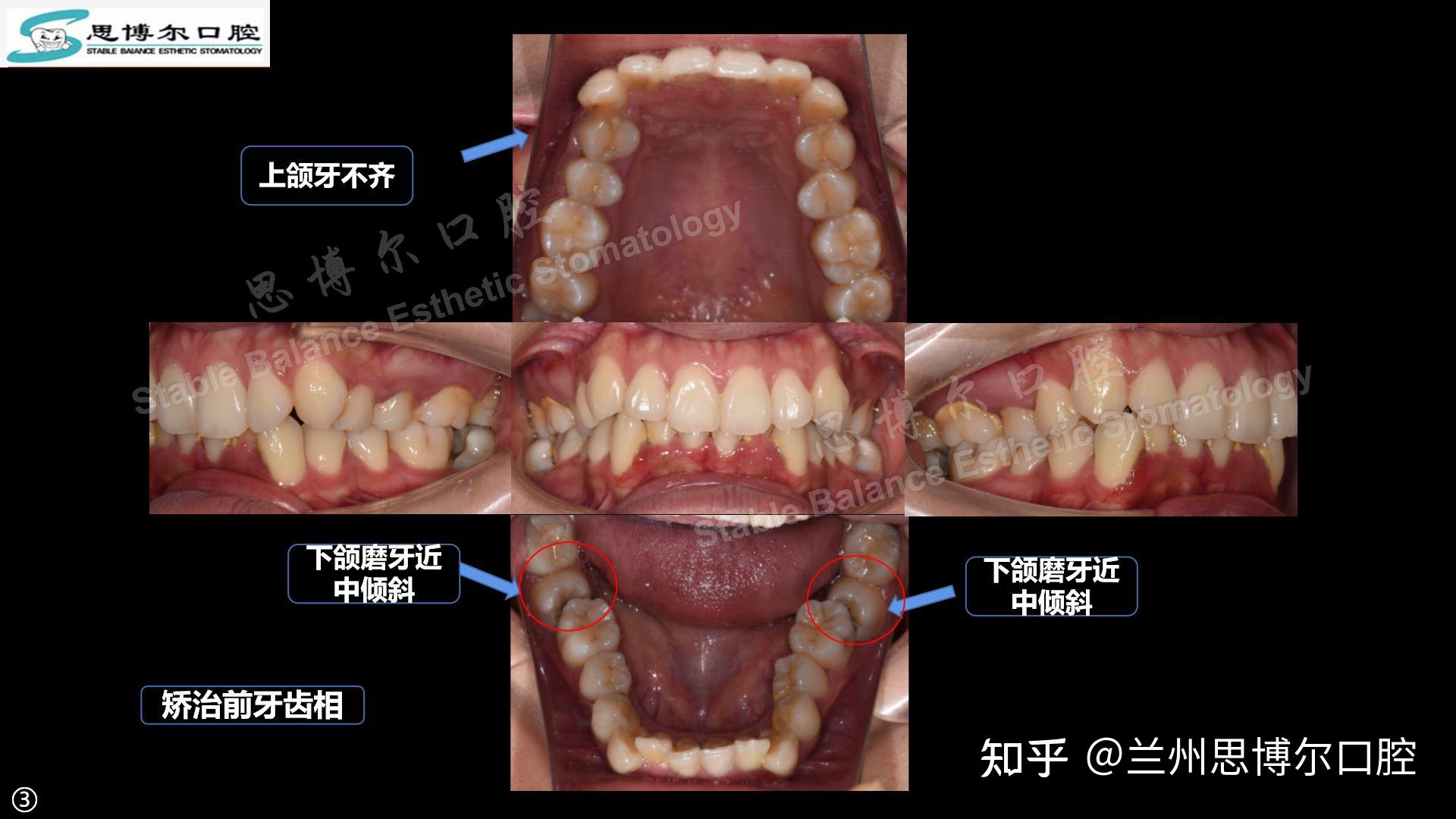 【附图】 S-ECC儿童广泛的右下第二乳磨牙龋坏及尚未完全萌出的右下第一恒磨牙龋坏 _口腔医学 | 天山医学院
