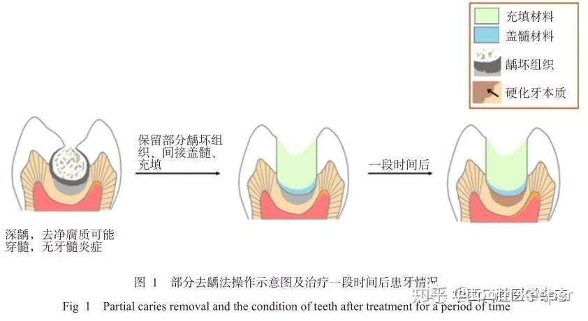 抽牙髓过程图解图片