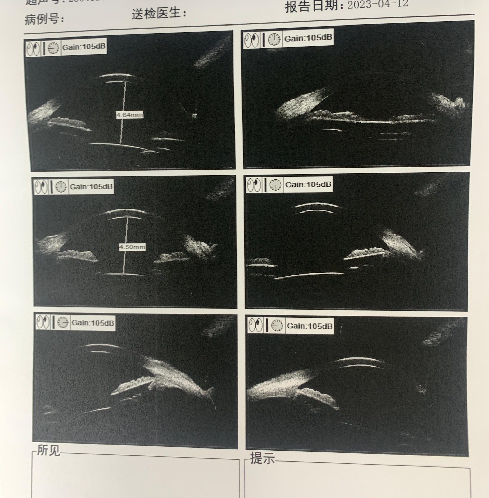 脉络膜脱离超声图图片