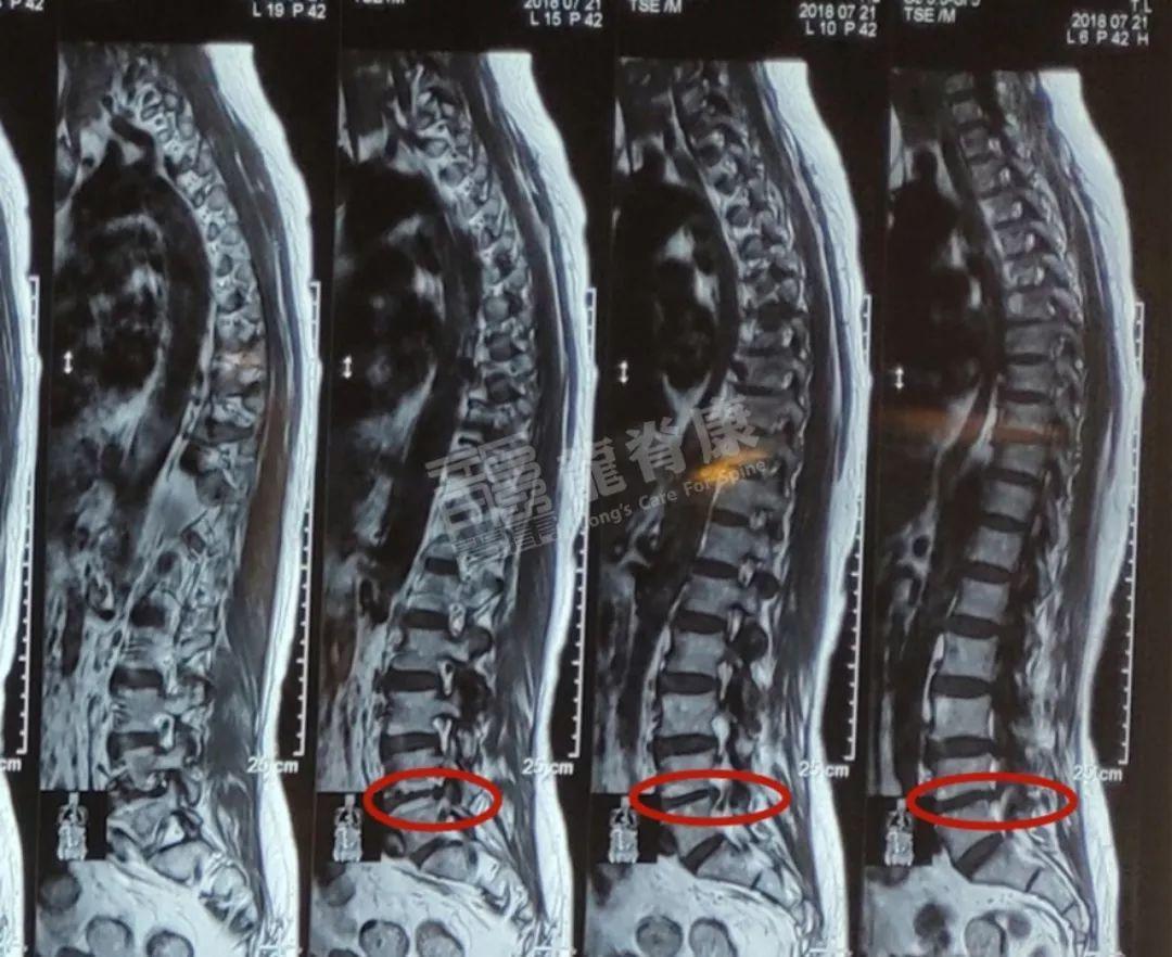 1/4,l2/3,l3/4,l4/5椎间盘向椎体周围膨出,相应硬脊膜受压,l3/4,l4/5