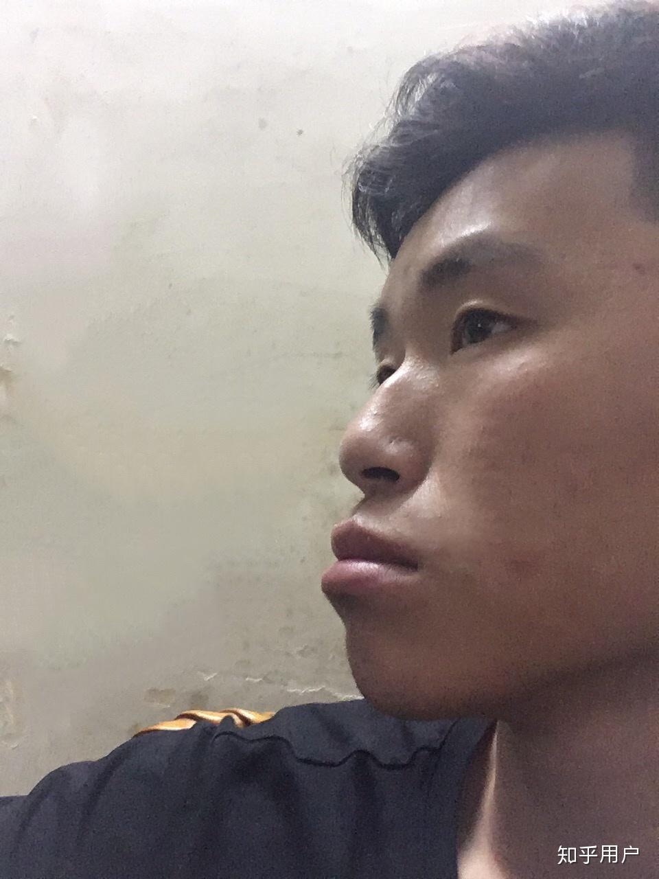 牙齿地包天兜齿是怎样的一种体验