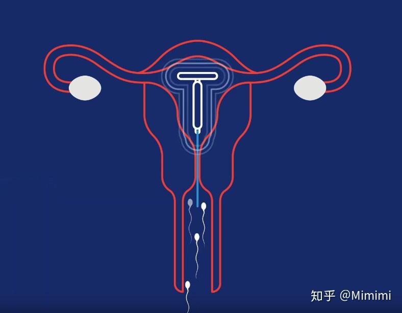 1宫内节育器:中国避孕界的冠军