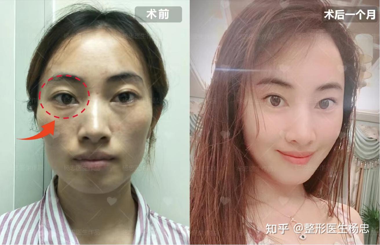 【眼眶凹陷】十分显疲惫,该怎么办? - 知乎