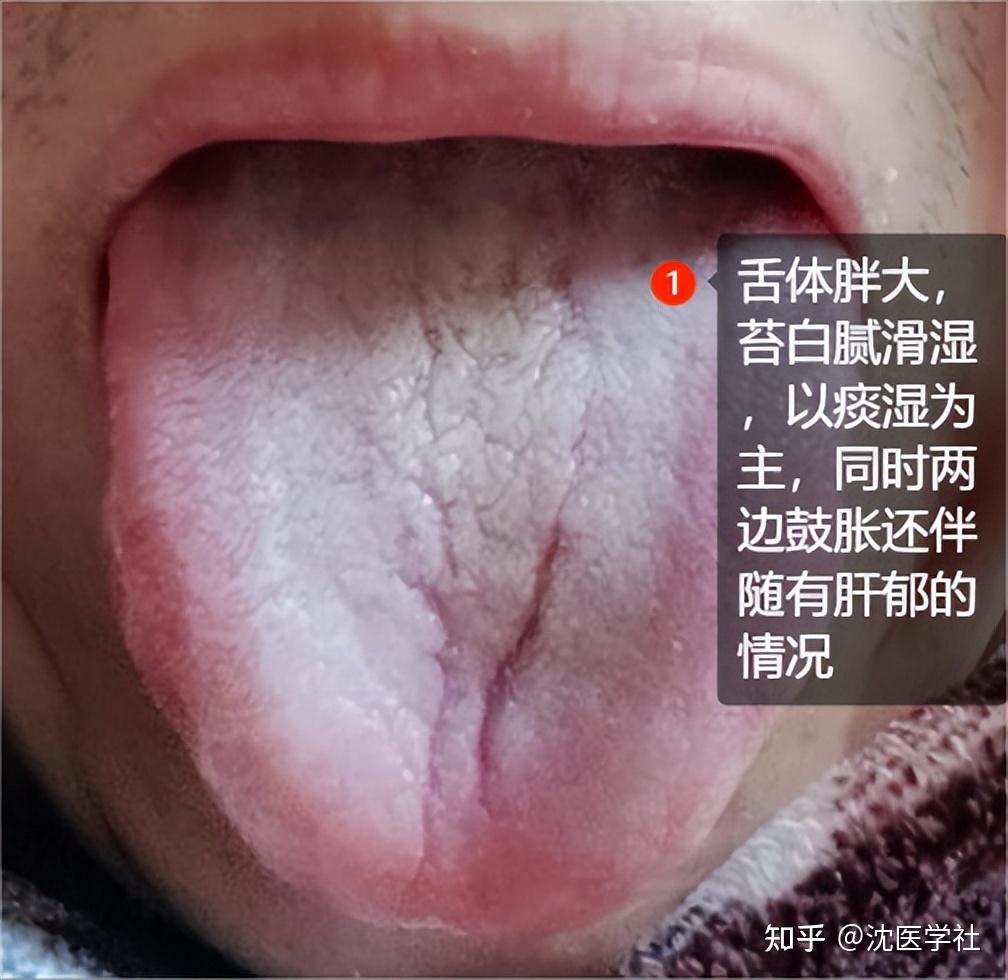 舌中有裂纹,得小心脾胃!常见的4大裂纹舌,今天一次给你讲清楚 - 知乎