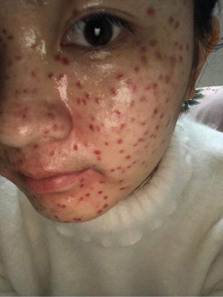 怎么去雀斑,激光祛斑怎么样?