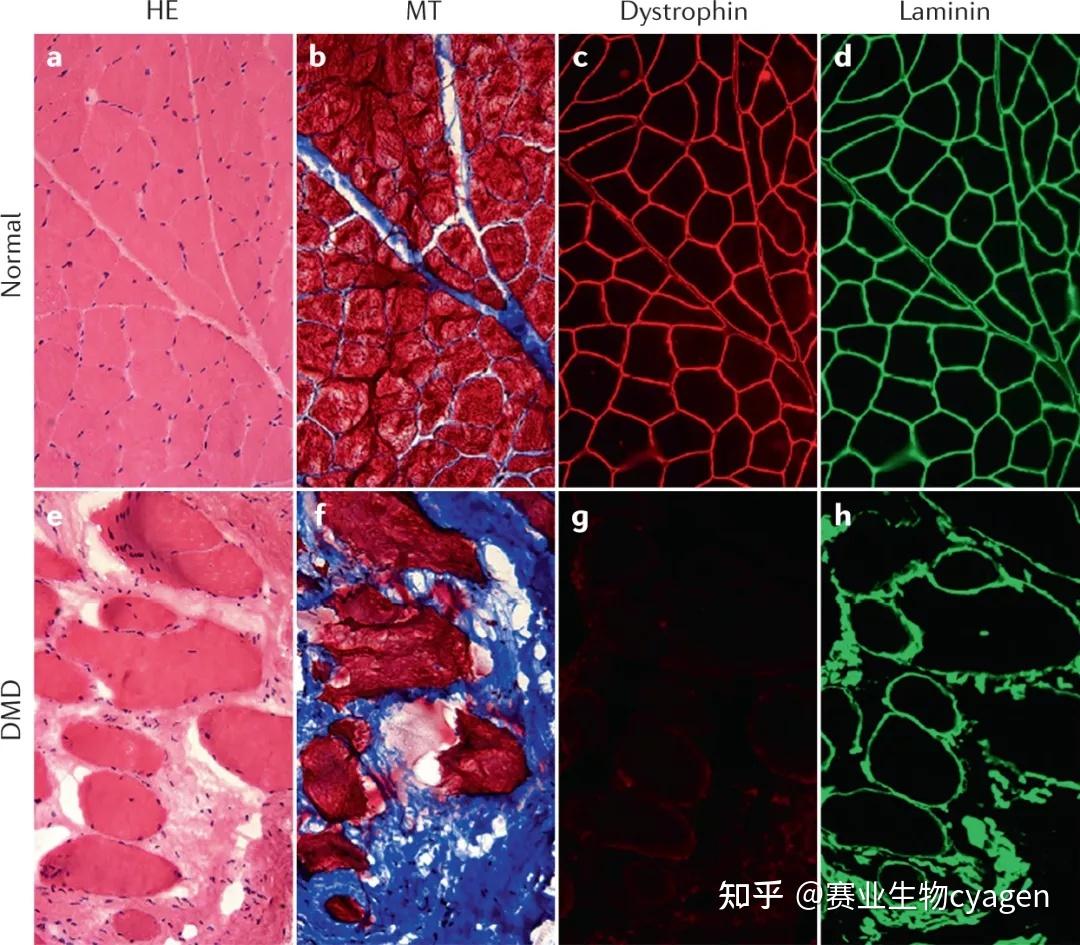 杜氏肌营养不良症(duchenne muscular dystrophy,dmd)是一种严重的x