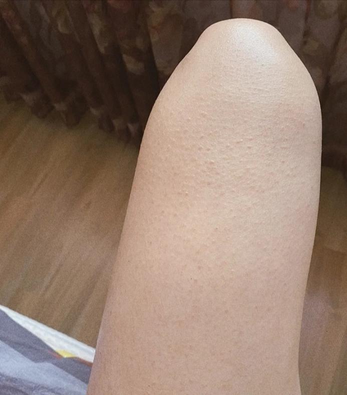 腿上鸡皮疙瘩怎么去除知乎(怎么才能去除腿上的鸡皮疙瘩)