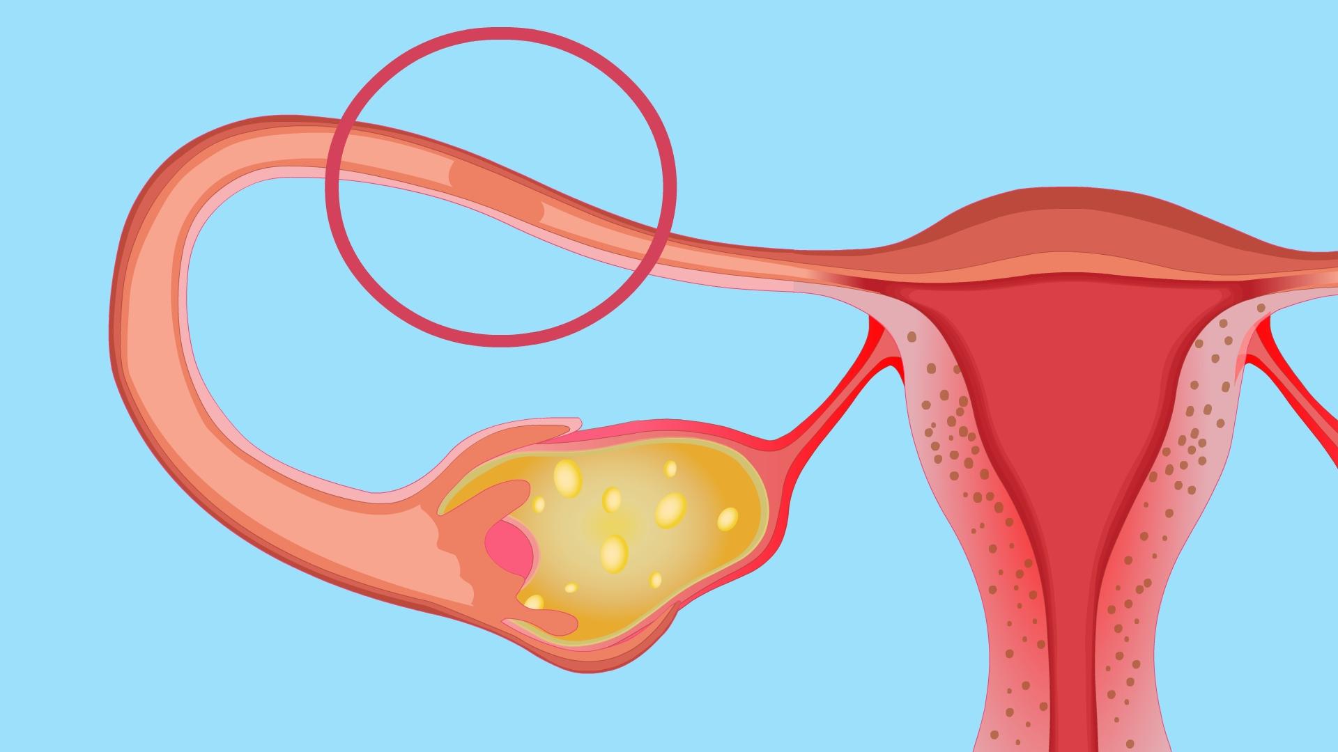 输卵管粘连有哪些症状？ - 知乎