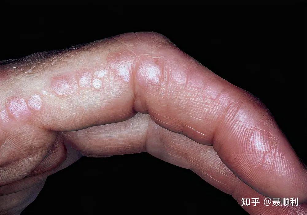 熟悉皮肌炎的皮肤改变少一些误诊上