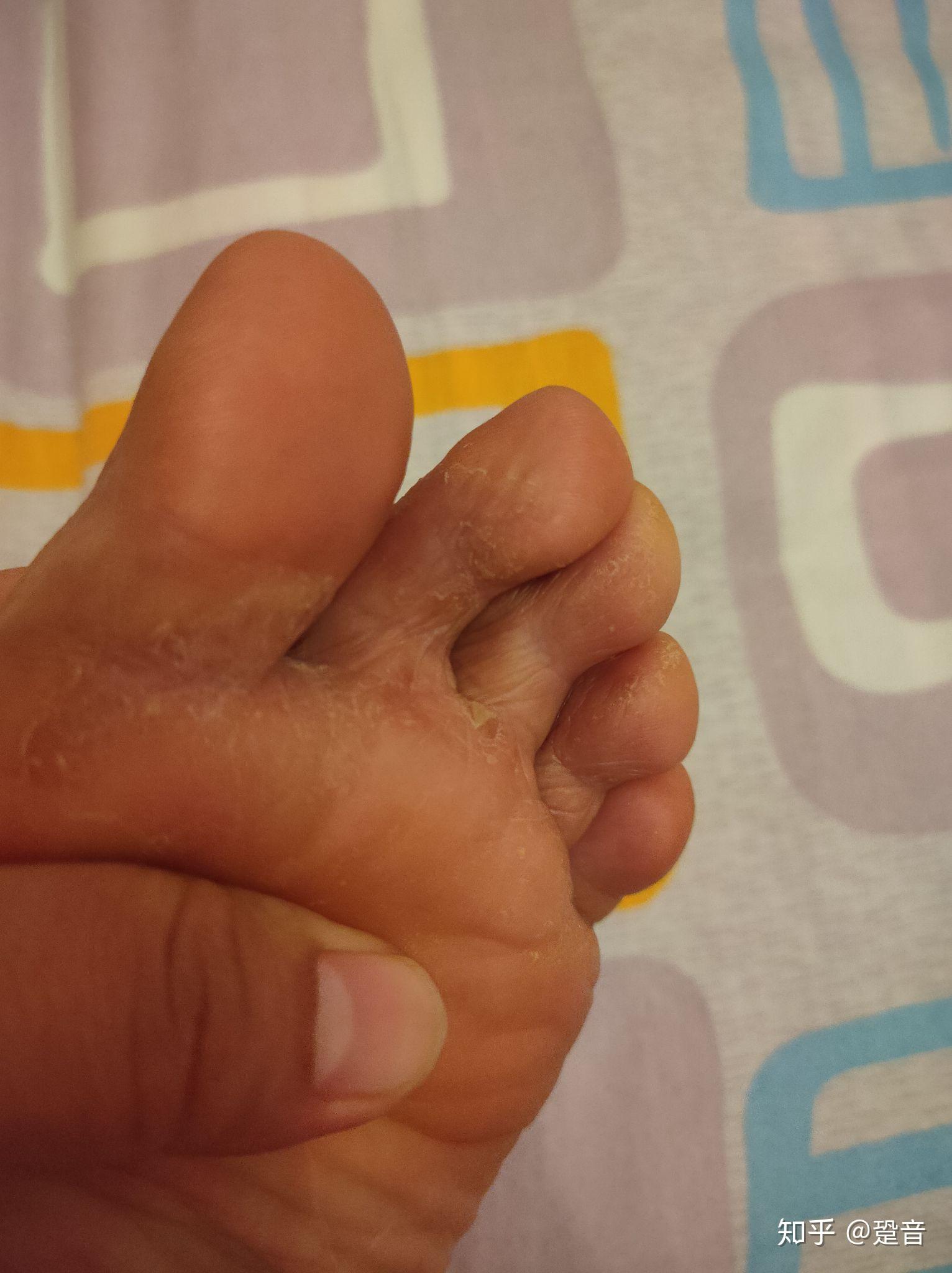 我的好物推荐脚气