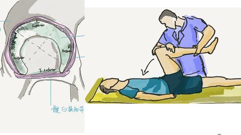 髋关节撞击综合症如何进行力量训练