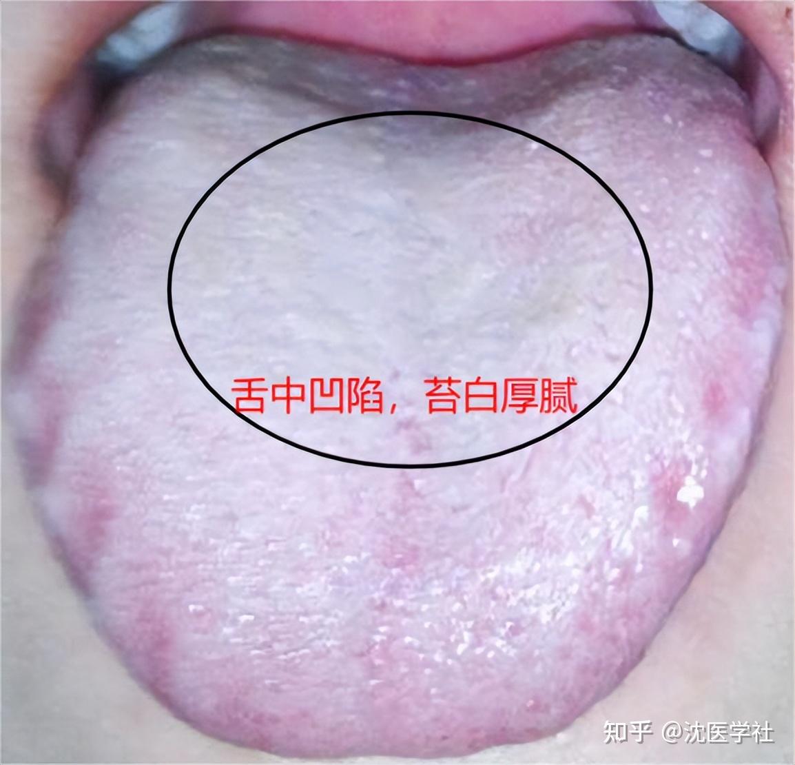 舌苔越厚,病根越深,厚腻苔在哪,问题就在哪!中医教你看舌辨病 - 知乎