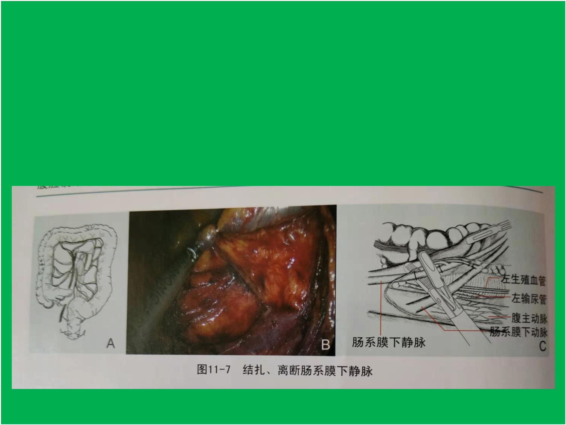 左半结肠癌手术步骤图图片