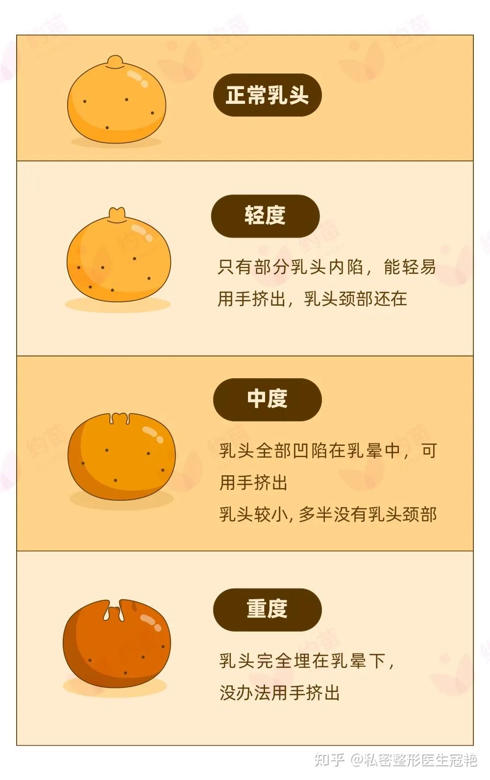 乳头凹陷咋办是乳腺癌吗