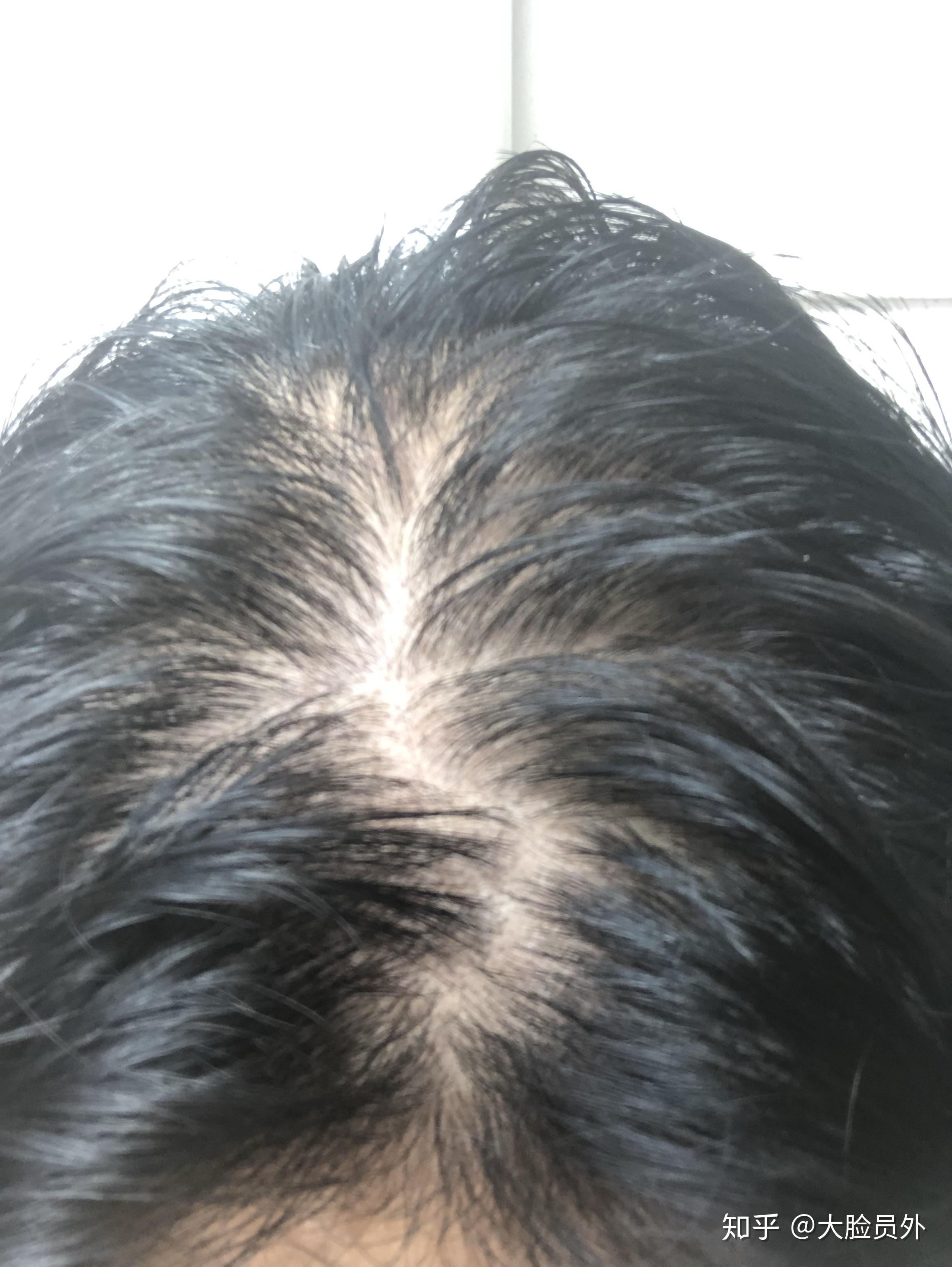 开帖记录脂溢性脱发治疗过程