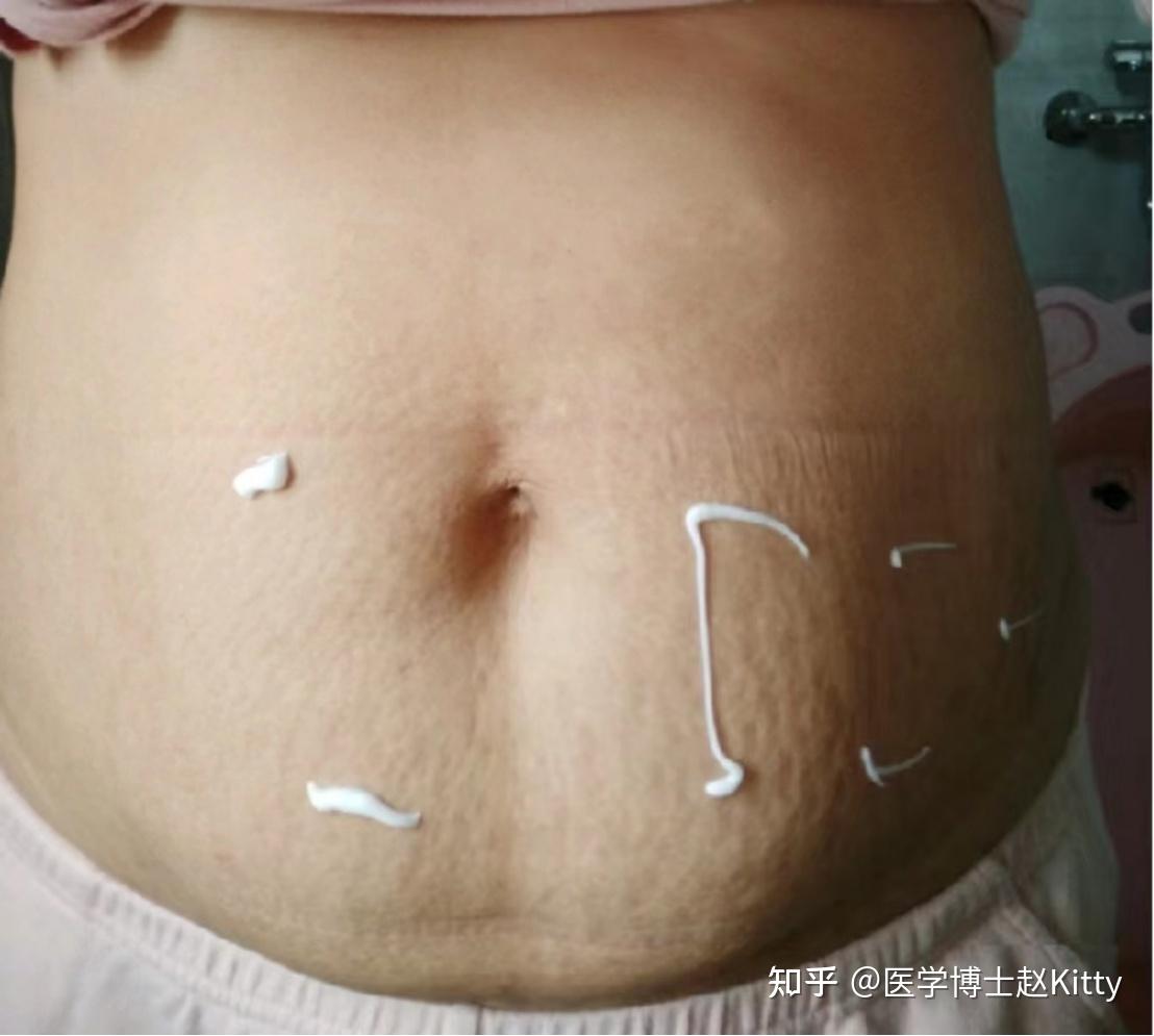 医美产后妊娠纹修复海报PSD广告设计素材海报模板免费下载-享设计