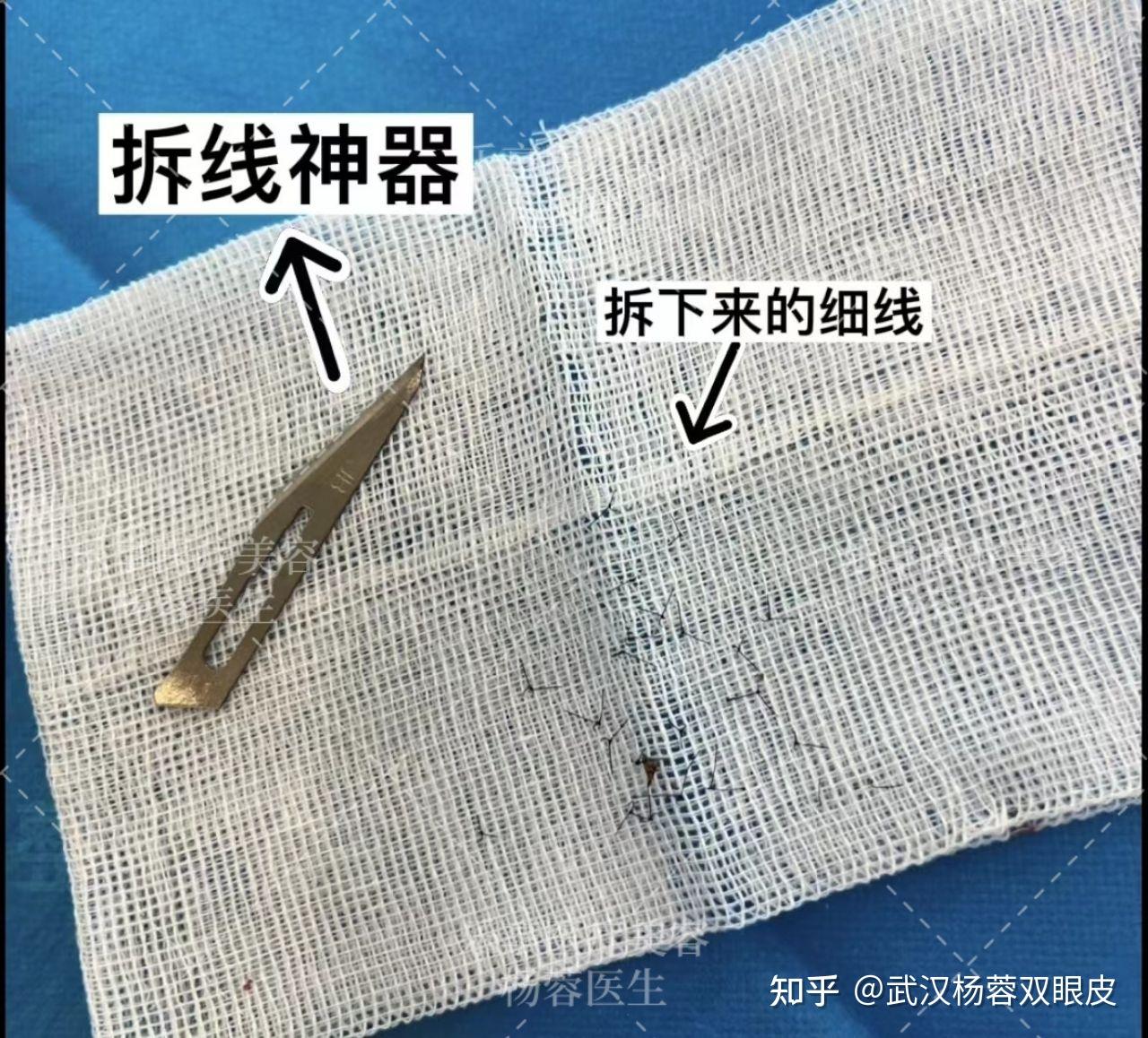 會比較麻煩雙眼皮縫合太密線太細用顯微鏡拆副主任醫師,美容主診醫師