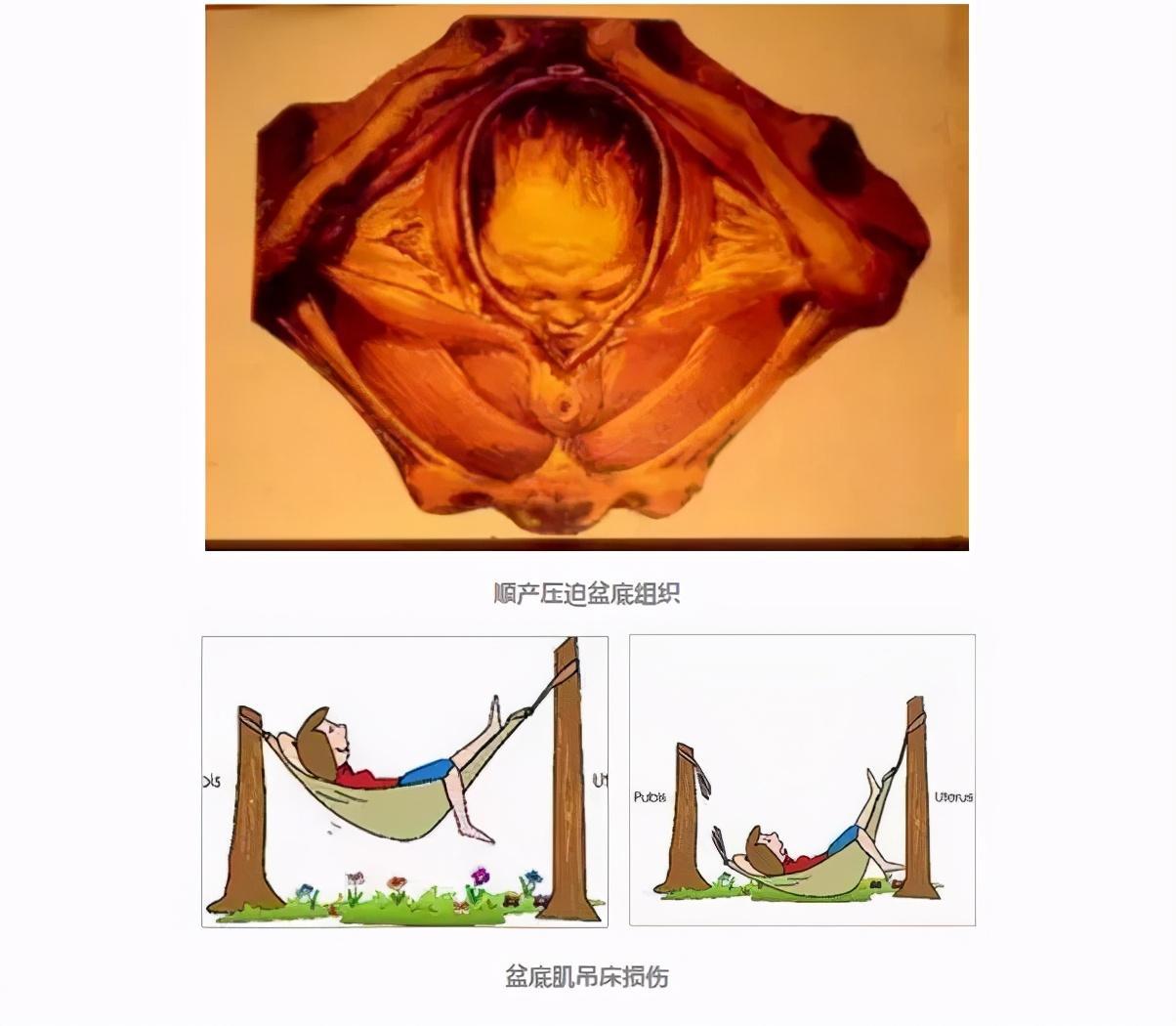 产后漏尿盆底肌松弛有多可怕几招教你告别尴尬