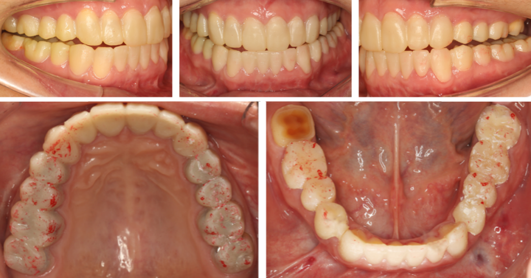 骨关节病合并牙列重度磨耗患者的咬合重建第七届口腔跨学科优秀病例展
