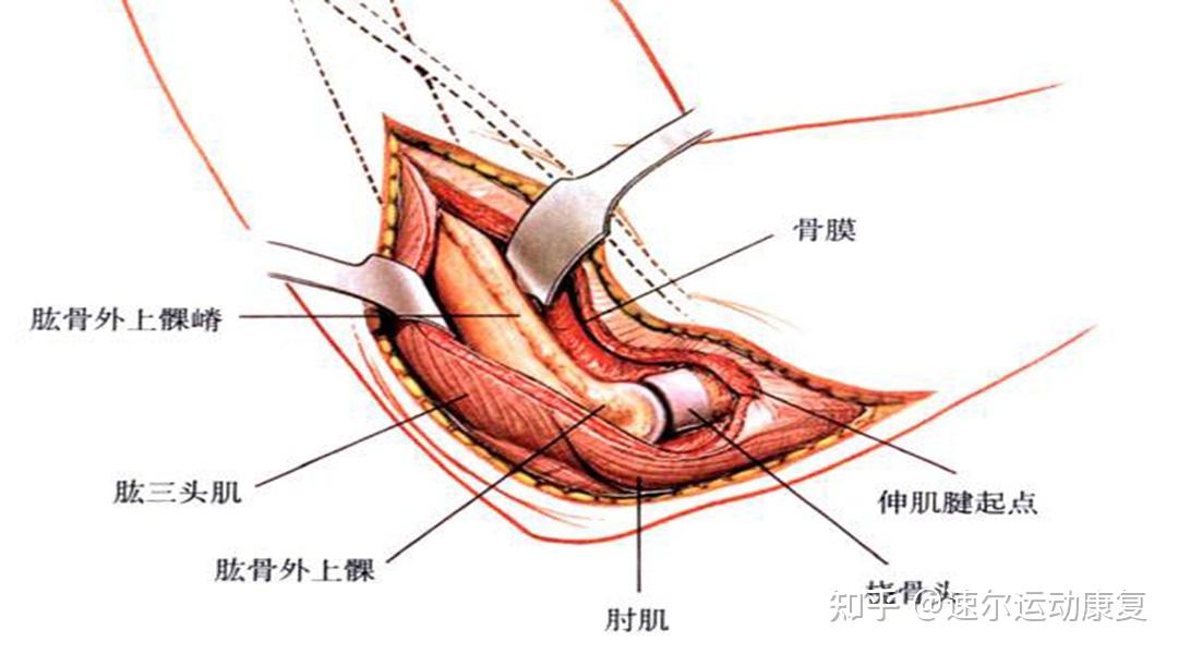 什么是网球肘?