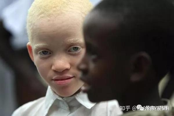 虽然白化病例在西方世界很少见,但在撒哈拉以南非洲很常见,可能是由于