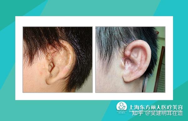 耳再造方式主要有几种 - 知乎