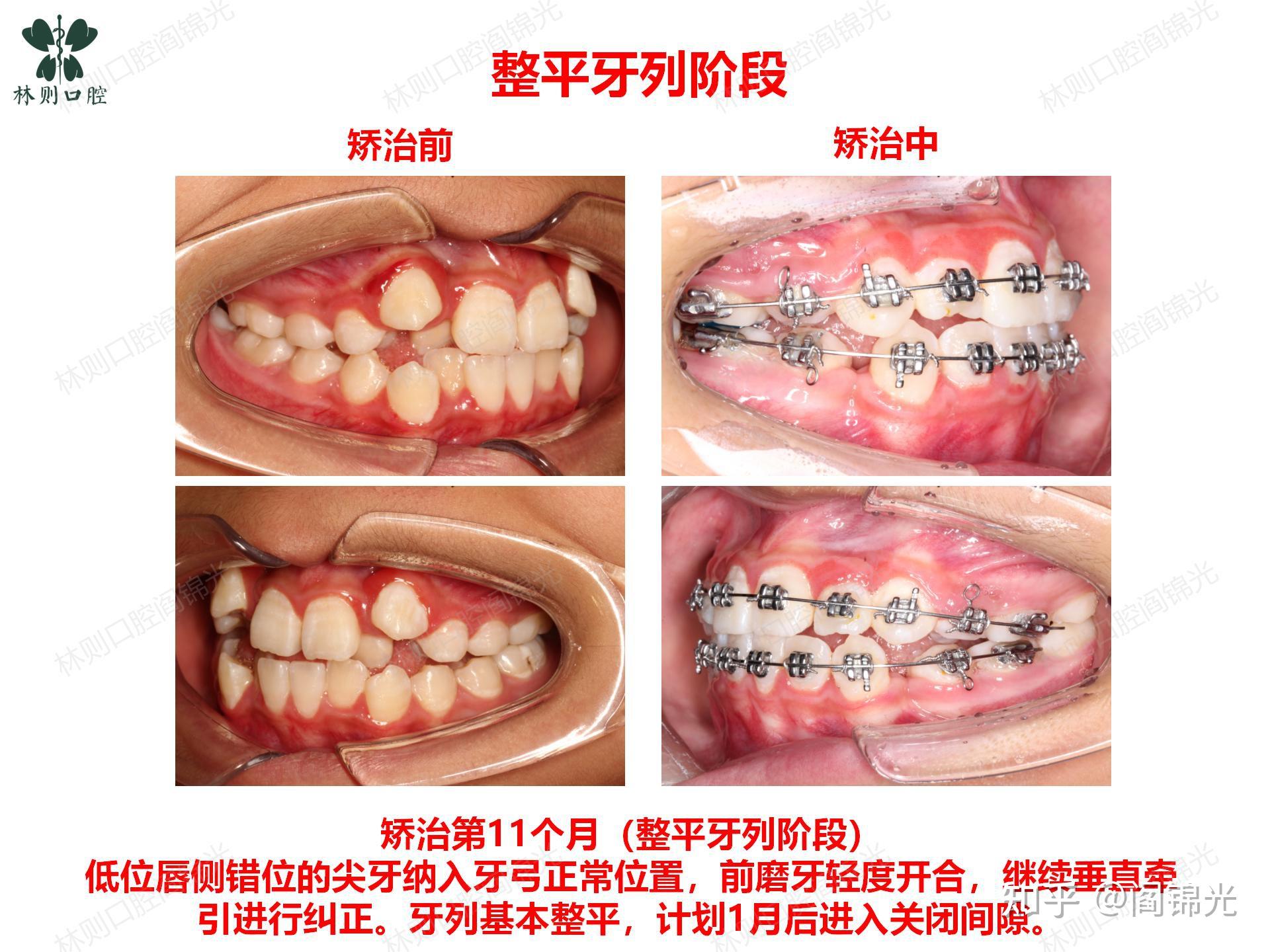 矯正牙齒案例嚴重牙齒擁擠不齊側切牙反合