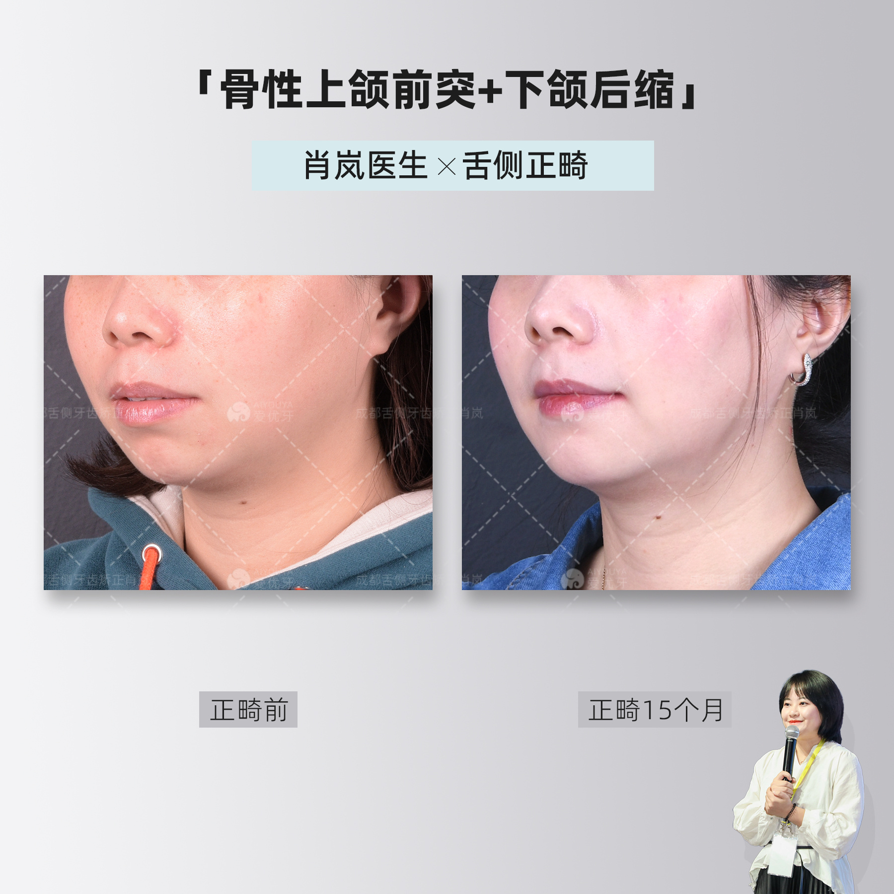 成都舌侧正畸|骨性上颌前突 下颌后缩,高难度案例