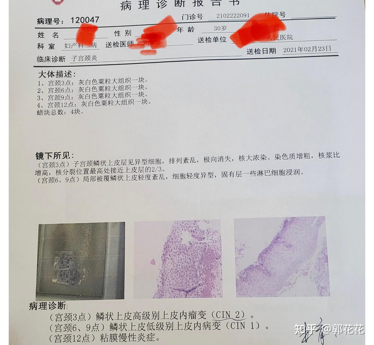 发现高危16型阳性后进行活检确定为cin1-2