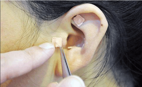 单耳埋针,或用王不留行籽贴压,每次选穴3一5个,3-5天更换i次,双耳交替