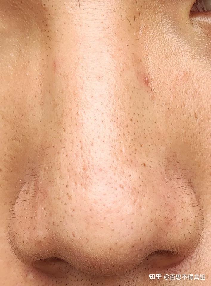 毳毛型假黑头的处理方法