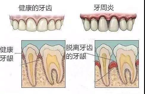 牙齿缝隙变大的原因 v2-4a58daf1751922bd2686791a2ab59b3f_1440w.jpg?source=172ae18b