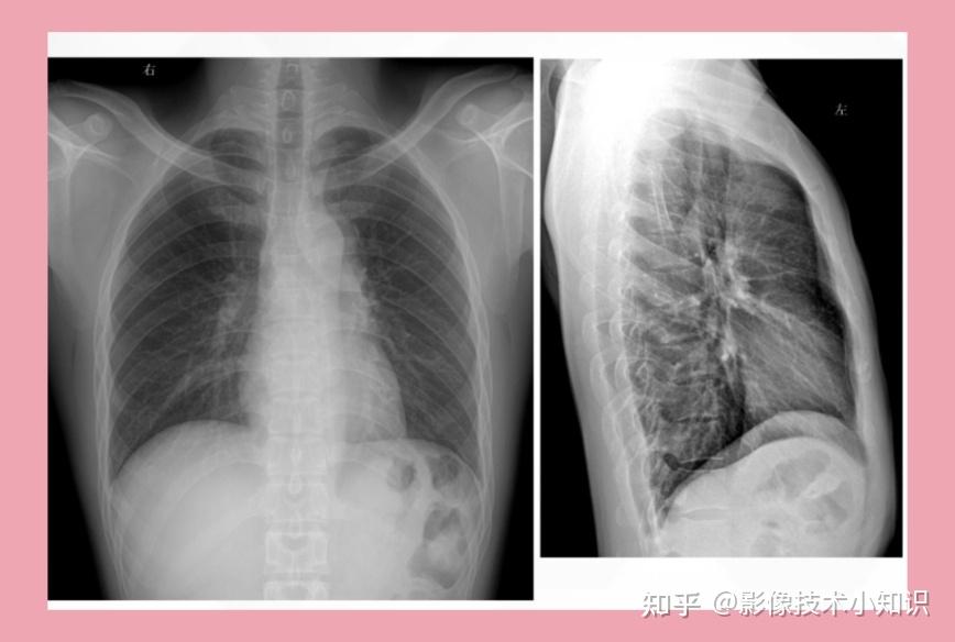 如何识别侧位胸片是左侧位还是右侧位 - 知乎