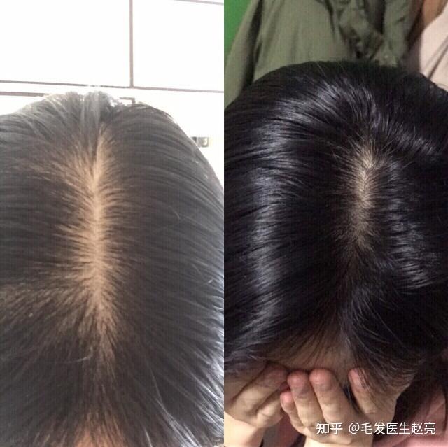脱发应如何分类呢