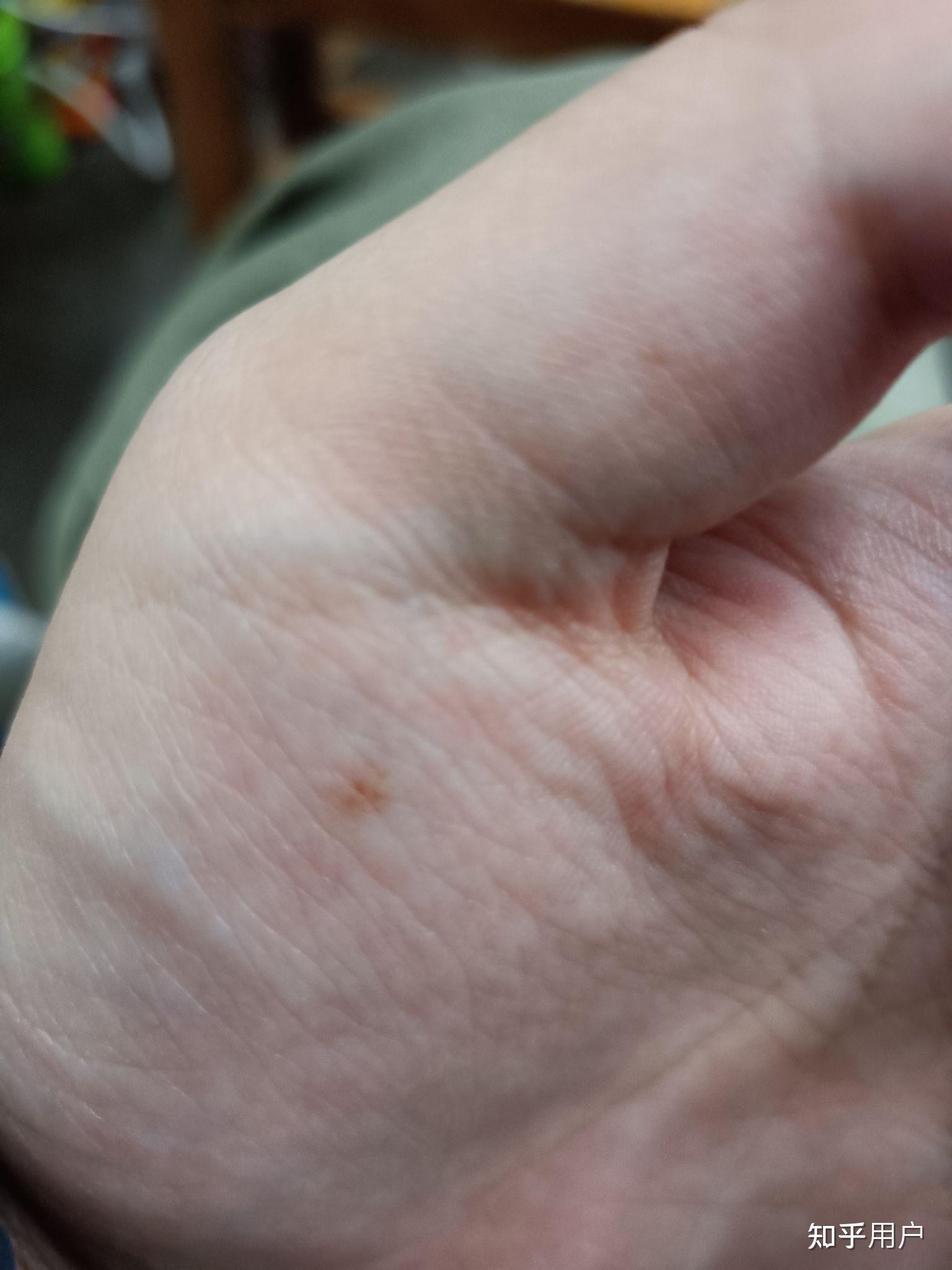 左手大鱼际有颗痣? - 知乎