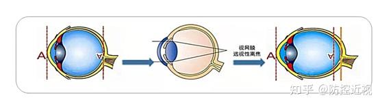 一文读懂近视防控神器——远像光屏(雾视屏) - 知乎