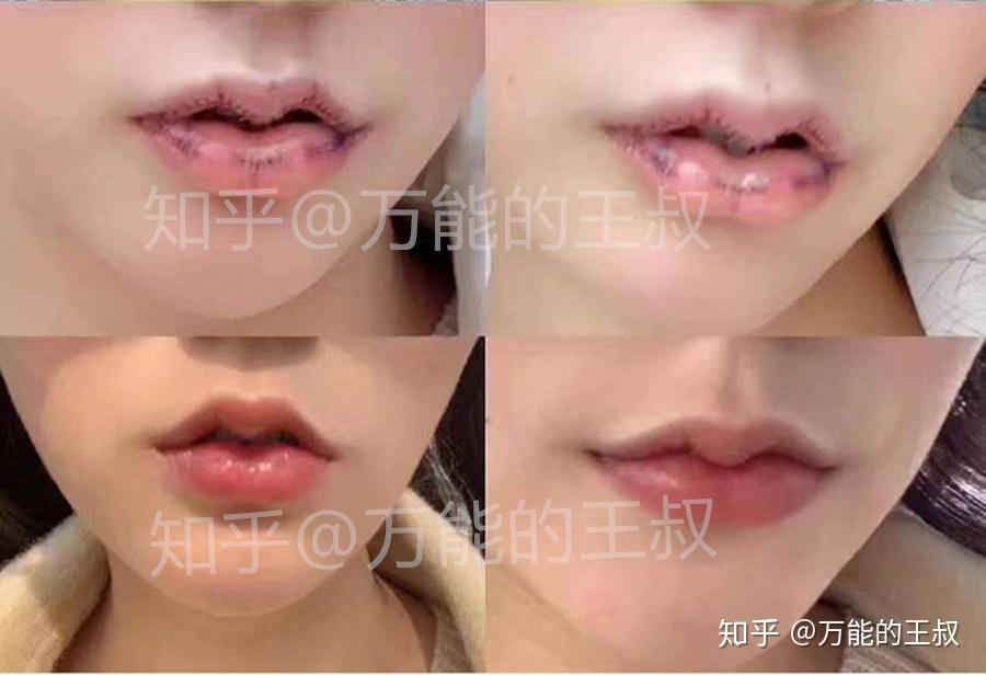 人中缩短花瓣唇m唇做决定之前你需要了解的那些事儿